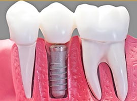 Dental Implants Landing Page 4