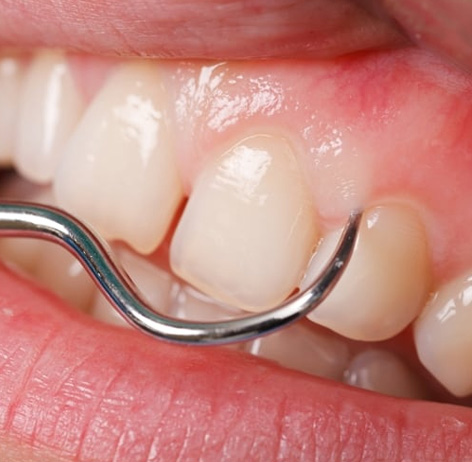 Close-up of receding gums before Gum Reshaping Hamilton