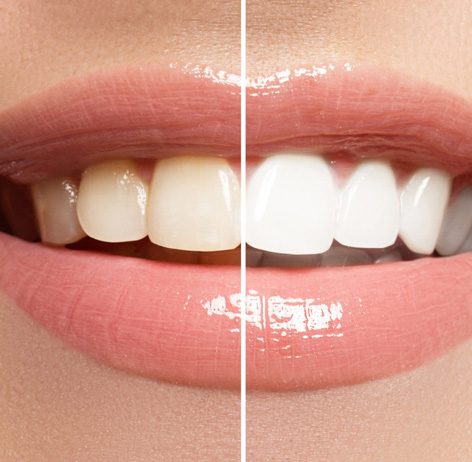 Before and after comparison of teeth given teeth whitening treatment