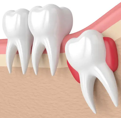 Wisdom Teeth 2