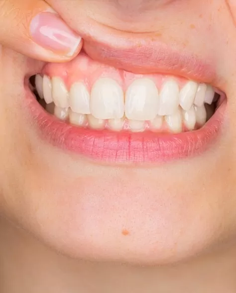 Young woman lifting top lip to show gum inflammation
