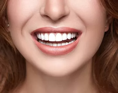 Bright smile with stunning porcelain veneers