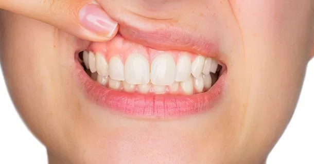 Young woman lifting top lip to show gum inflammation