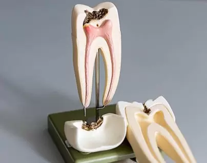 Cross-section of model tooth requiring root canal therapy