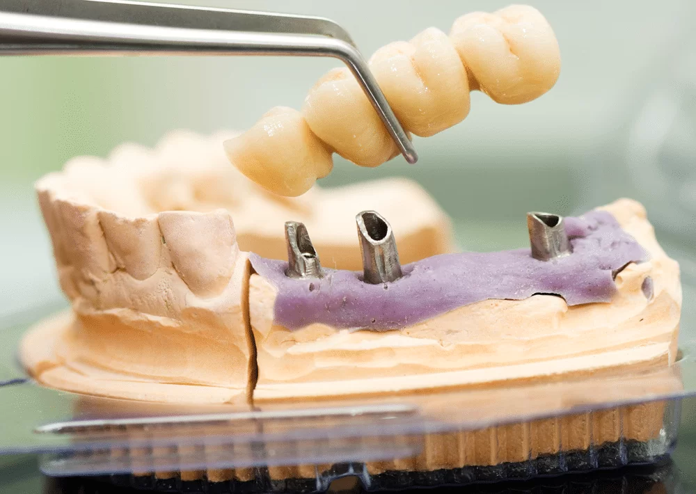 Custom dental bridge being applied to plaster model